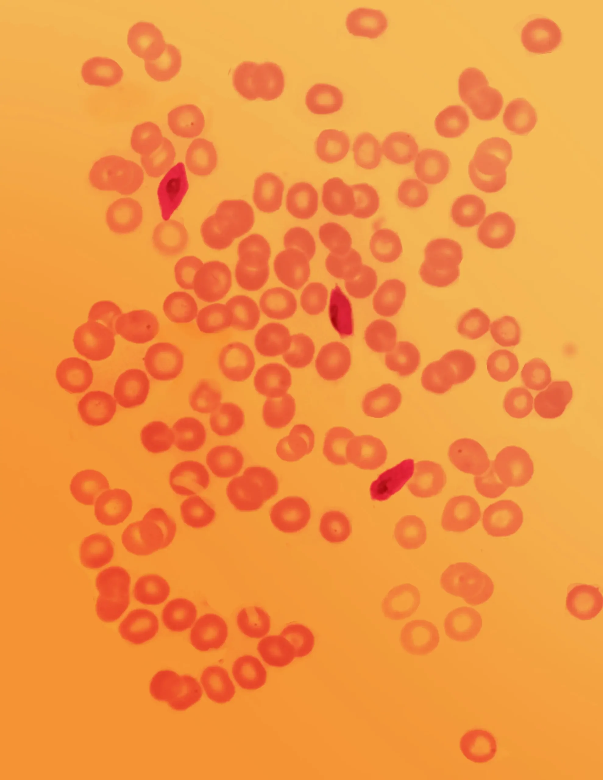 Microscopic view of many round red blood cells with a few elongated, crescent-shaped cells on an orange background, illustrating sickle cell disease during the Operation Outbreak simulation.